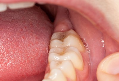 Cách khắc phục viêm lợi răng hàm hay tái phát! THAM KHẢO NGAY 